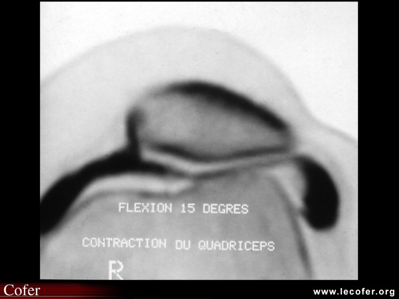 Lésions du cartilage par arthroscanner