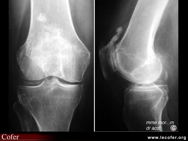 Gonarthrose et chondralcinose articulaire