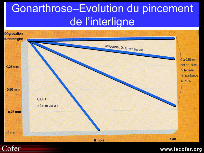 Gonarthrose, profil évolutif de la gonarthrose