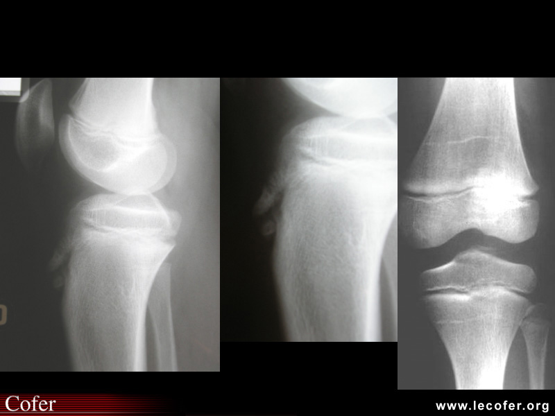Maladie d'Osgood-Schlatter et ostéochondrite disséquante du condyle fémoral