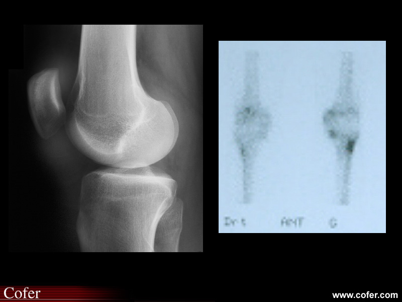 Spondylarthrite ankylosante: enthésite du genou