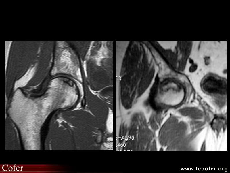 OstéoNécrose Aseptique de Hanche (ONAH) : IRM T1