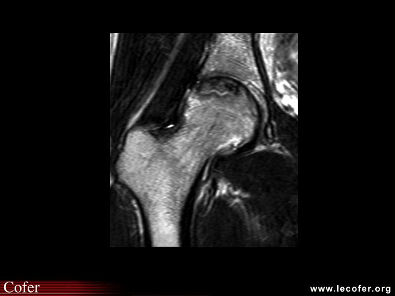 OstéoNécrose Aseptique de Hanche (ONAH) : IRM T2 aspect en « double ring »