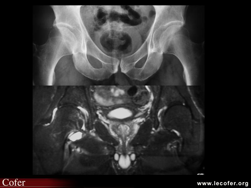 Polyarthrite rhumatoïde : anomalies de la hanche droite (polyarthrite rhumatoïde)