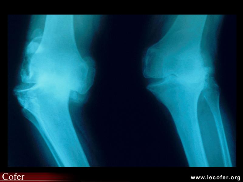 Radiographie des genoux : arthropathie destructrice avec subluxation fémoro-tibiale