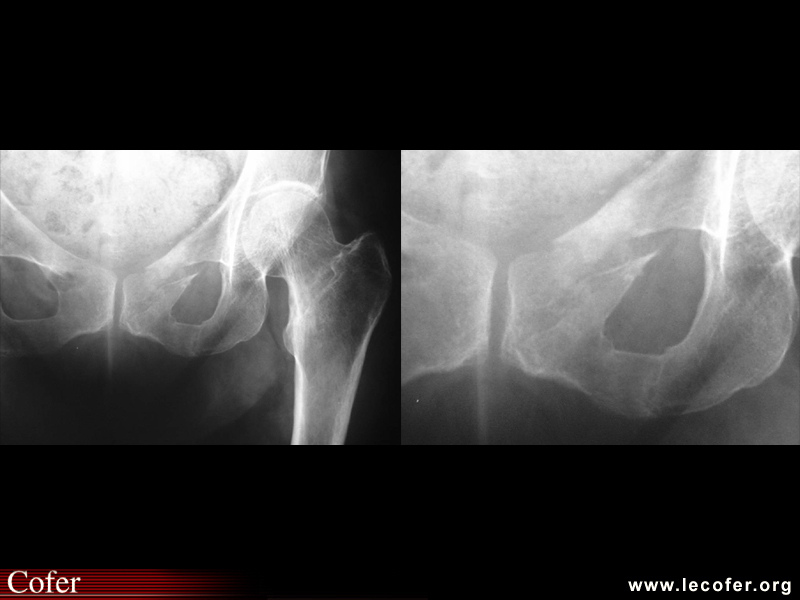 Fracture des branches ischio-pubiennes et ilio-pubiennes