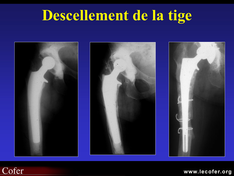 Chirurgie : signes de descellement