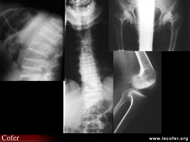 Dysplasie spondylométaphysaire