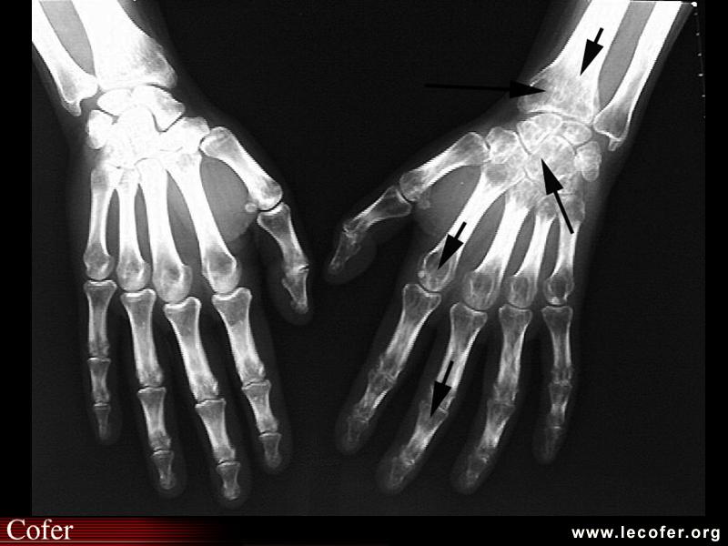 Algoneurodystrophie, algodystrophie de la main : radiographies