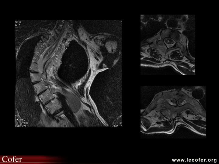 Diastématomyélie et scoliose