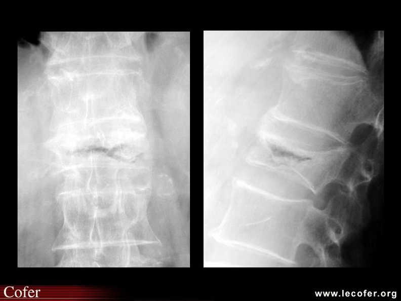 Ostéonécrose vertébrale : radiographies