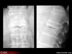 Ostéonécrose vertébrale : radiographies