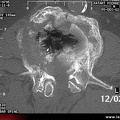 Ostéonécrose vertébrale : tomodensitométrie