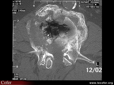 Ostéonécrose vertébrale : tomodensitométrie