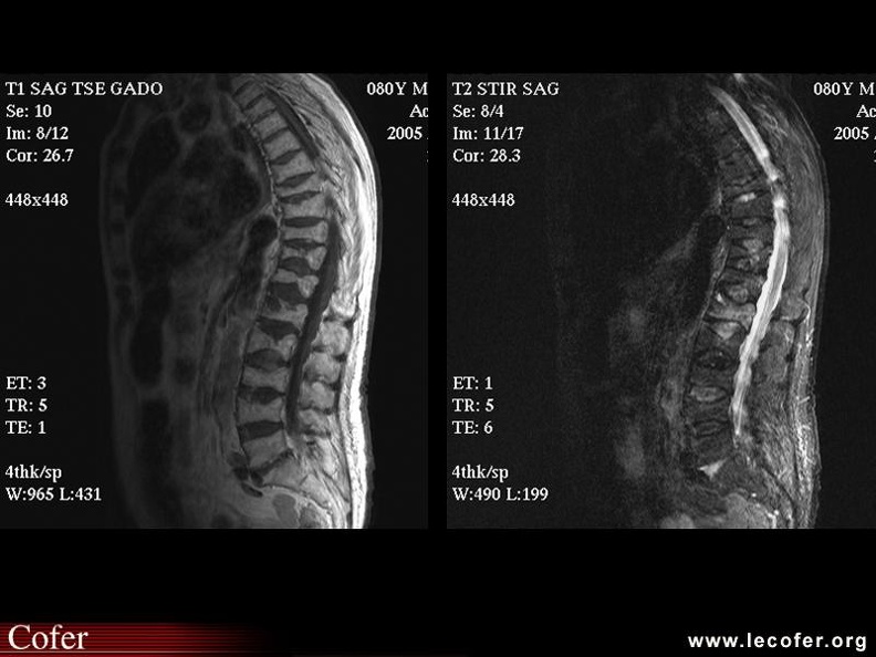 Fractures vertébrales