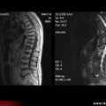 Fractures vertébrales