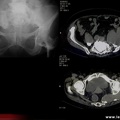 Tuberculose osseuse : abcès du psoas et du sacrum