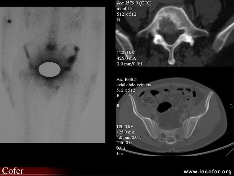 Métastase osseuse (cancer poumon). 000000000284.jpg