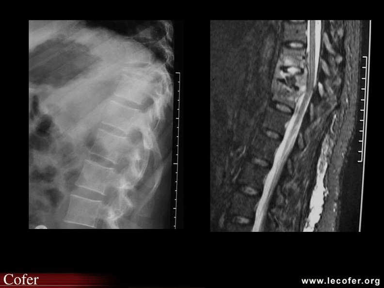 Spondylodiscite tuberculeuse