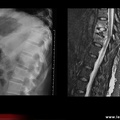 Spondylodiscite tuberculeuse