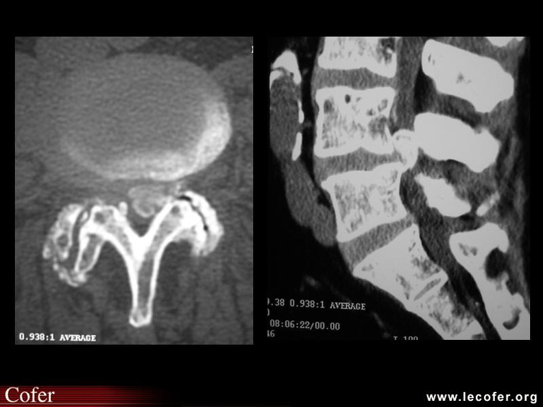 Arthrose interapophysaire évoluée, protusion discale et ostéophyte endocanalaire. 000000000322.jpg