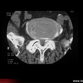 Canal lombaire étroit par arthrose interapophysaire postérieure