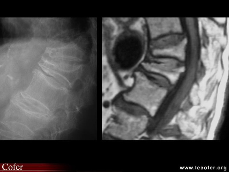 Ostéoporose : fractures vertébrales