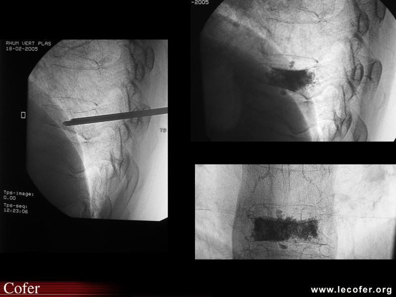 Vertébroplastie : aspect radioscopique