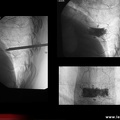 Vertébroplastie : aspect radioscopique