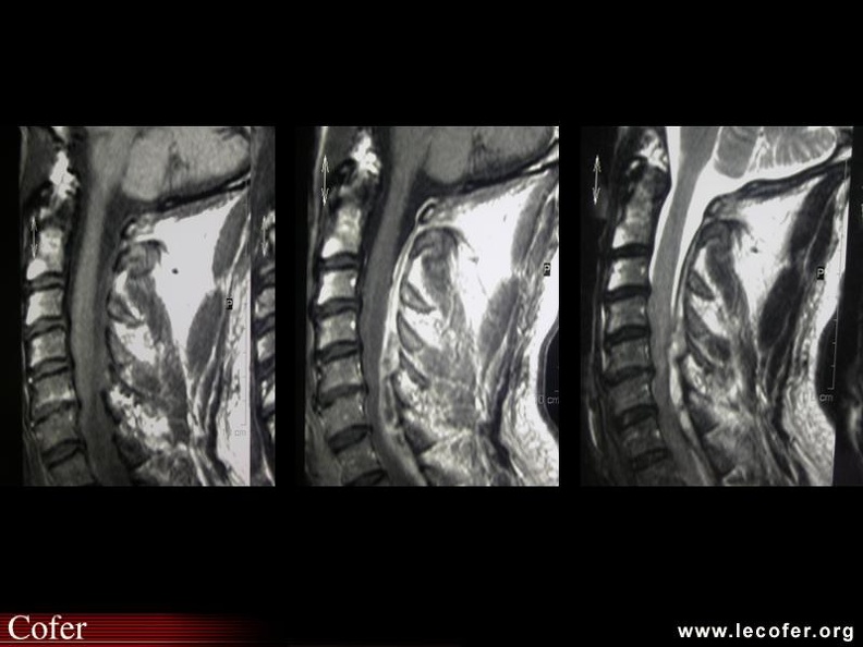 Abcès épidural cervical (T1, T1 gadolinium et T2). 000000000353.jpg