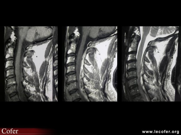 Abcès épidural cervical (T1, T1 gadolinium et T2)