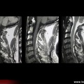 Abcès épidural cervical (T1, T1 gadolinium et T2)