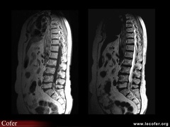 Tumeur épidurale lombaire : liposarcome (pondération T1 et T2)