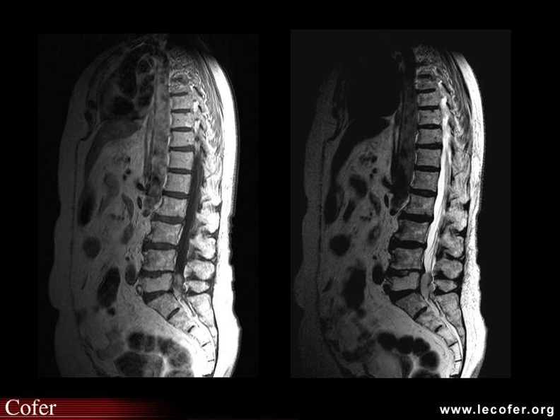 Tumeur épidurale lombaire : liposarcome (pondération T1 et T2)