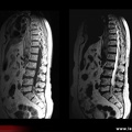 Tumeur épidurale lombaire : liposarcome (pondération T1 et T2)