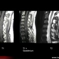 Astrocytome cervical