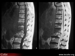 Lymphome vertébral