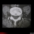 Hernie discale foraminale mimant un neurinome