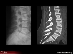 Pycnodysostose (anomalies vertébrales)