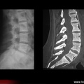 Pycnodysostose (anomalies vertébrales)