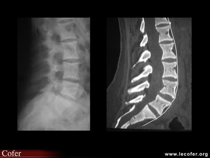 Pycnodysostose (anomalies vertébrales)