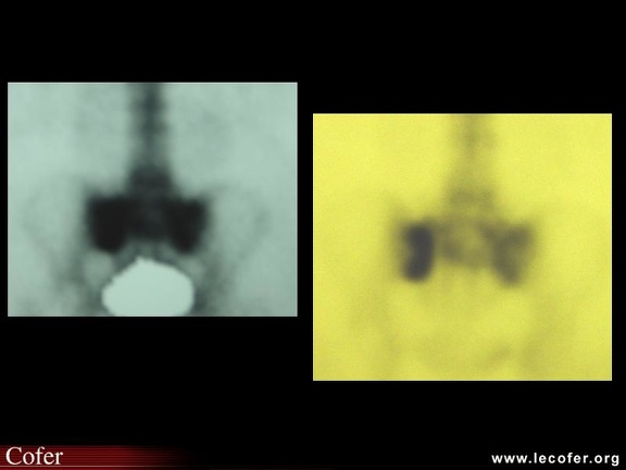 Fissure du sacrum / fracture par insuffisance osseuse du sacrum