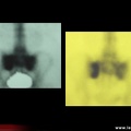 Fissure du sacrum / fracture par insuffisance osseuse du sacrum