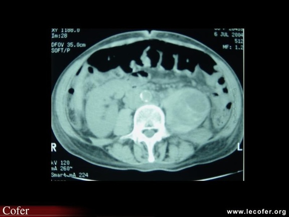 Cruralgie : hématome du psoas