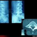 Spondylolyse