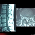 Hernie discale en IRM / pathologie vertébrale commune