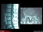 Hernie discale en IRM / pathologie vertébrale commune