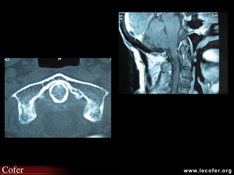 Arthrite microcristalline / chondrocalcinose : syndrome de la dent couronnée