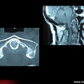 Arthrite microcristalline / chondrocalcinose : syndrome de la dent couronnée