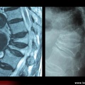 Ostéoporose : fractures vertébrales multiples